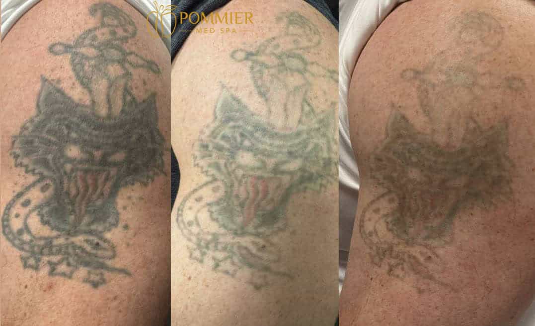 Laser Tattoo Removal Progression 2 3