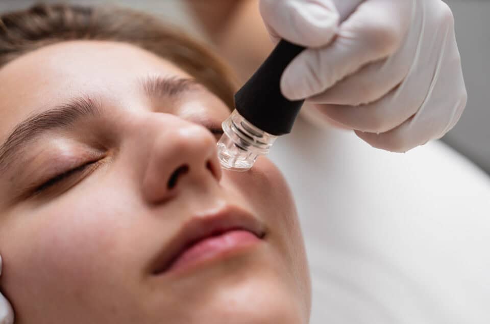 Microneedling