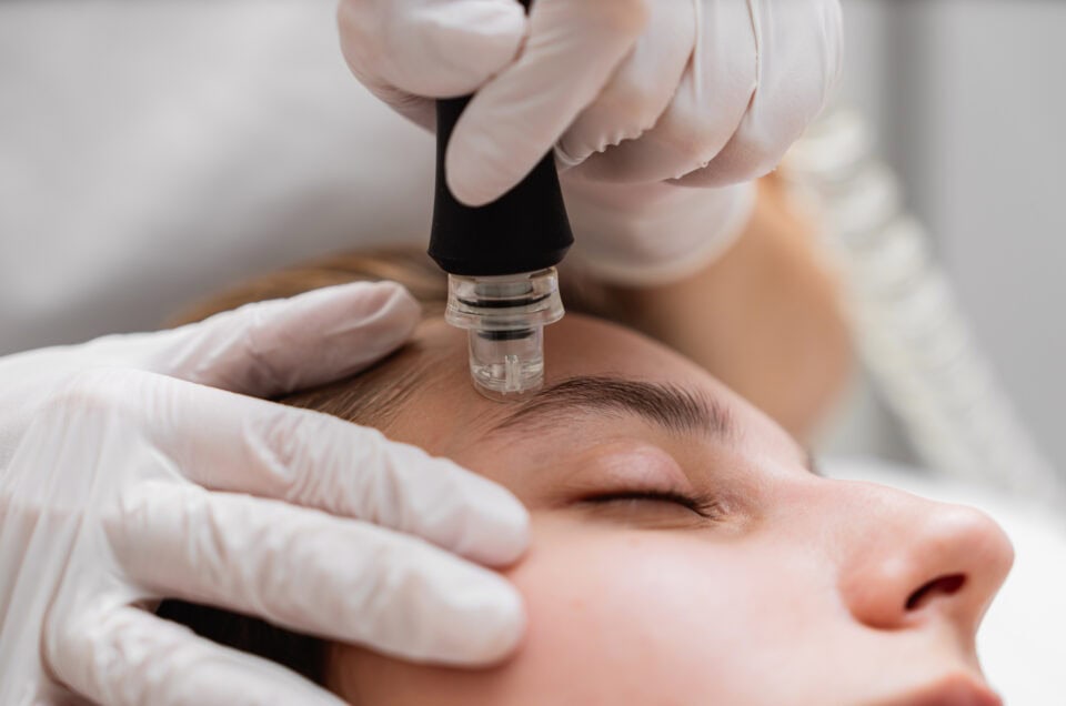 How Long Do Microneedling Results Last?