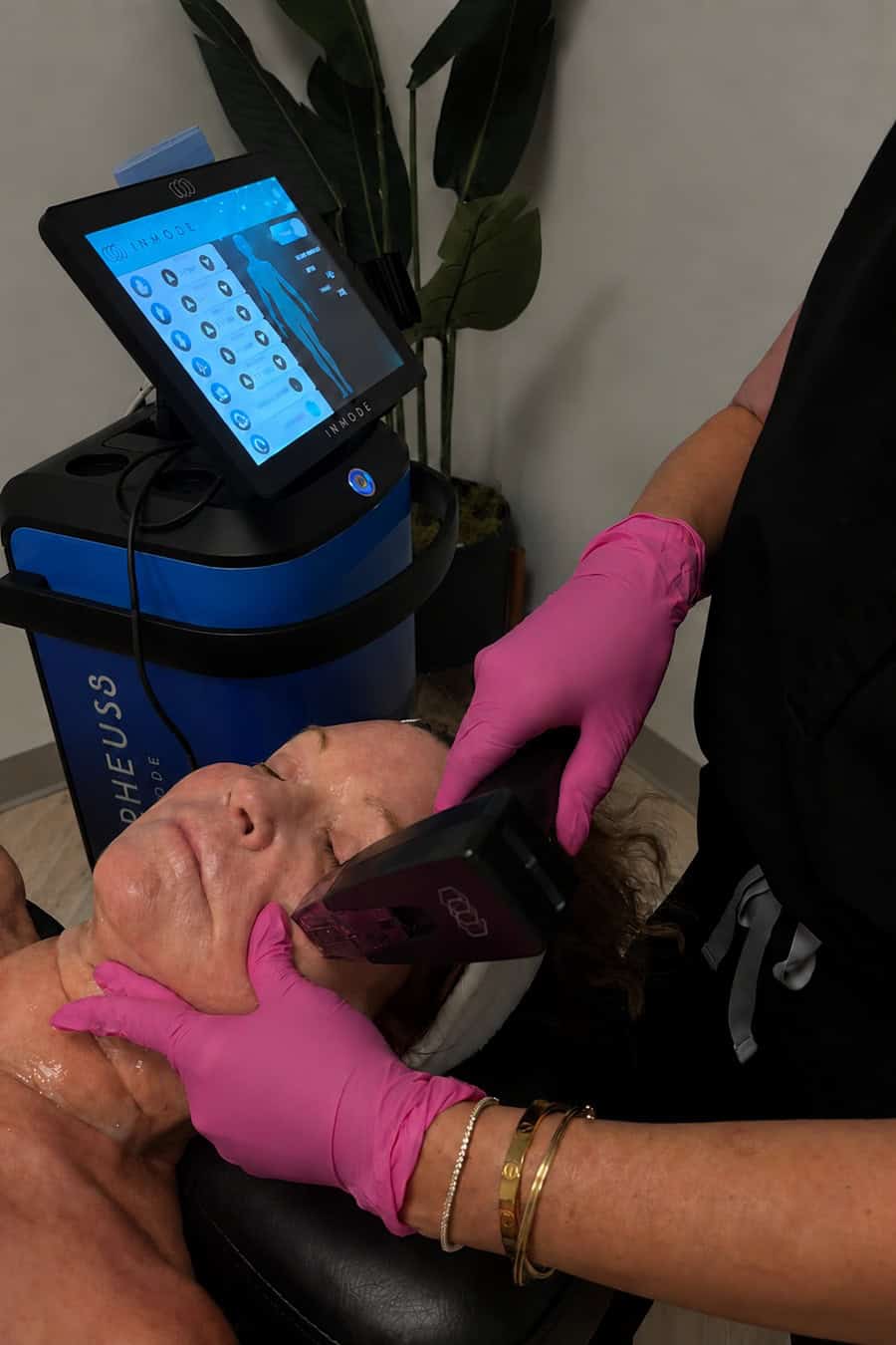 Morpheus8 microneedling treatment at Pommier Med Spa